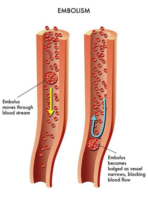 Embolia Conheça 8 Causas 9 Sintomas 3 Tratamentos Prevenção E 10