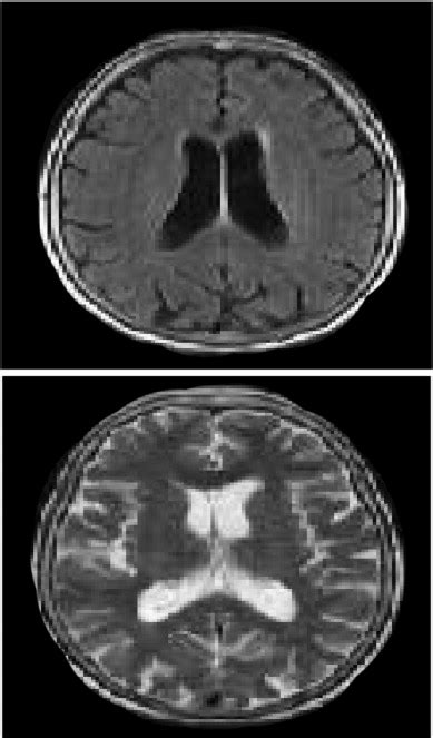 Clinical Manifestations Diagnostic Criteria And Therapy Of Hashimotos