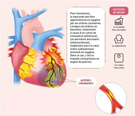 Linfarctus Du Myocarde Vocation Sant