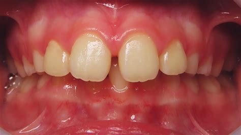 Class Ii Division 1 Malocclusion Early Mixed Dentition Excessive Overjet And Overbite Case