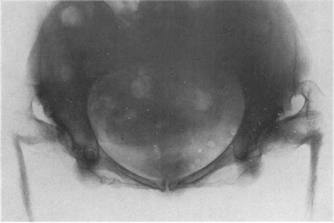 Figure 1 From Congenital Coxa Vara Patella Aplasia And Tarsal