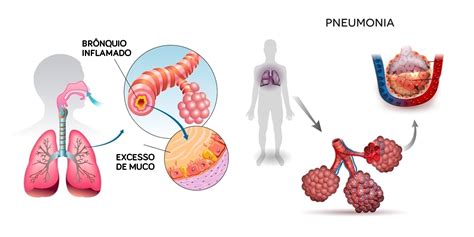 Você sabia que pneumonia é diferente de bronquite Aprenda a diferenciar