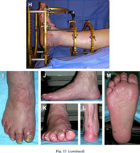 Figure 1 From Minimally Invasive Soft Tissue And Osseous Stabilization