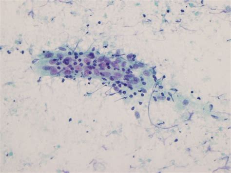 GO BIG or GO HOME: Tuberculous lymphadenitis