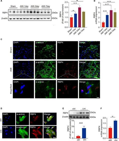 RBP4 Retinol Binding Protein 4 Expression Is Increased In Acute