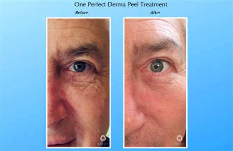 The Perfect Derma Peel Advanced Skin Body Solutions