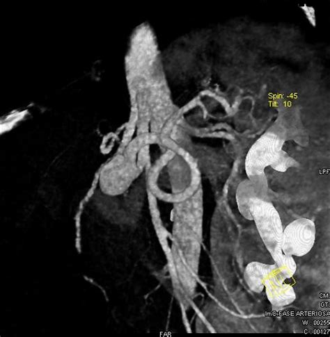 Surgical Repair Of An Aberrant Splenic Artery Aneurysm Report Of A Case Annals Of Vascular