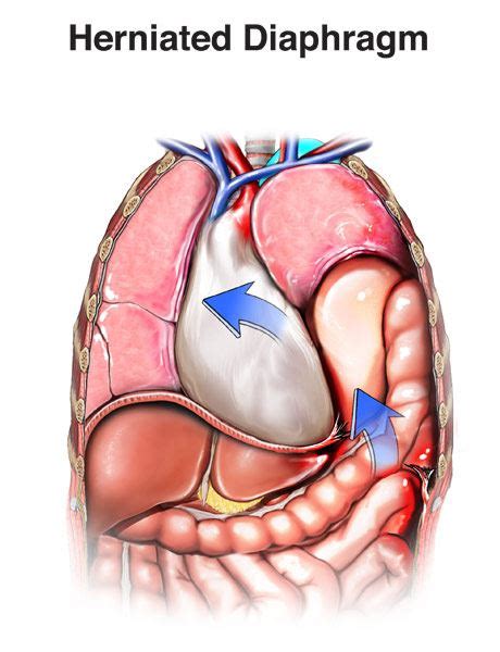 Traumatic Diaphragmatic Hernia