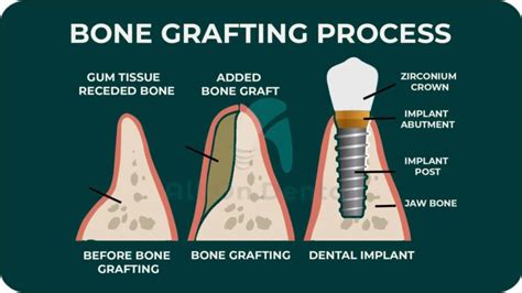 Bone Graft Allondental