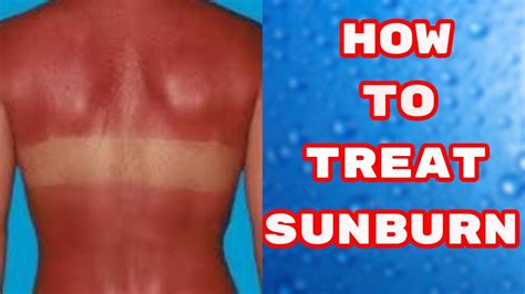 How To Treat Sunburn At Home Easy And Effective Home Remedies For Sunburn Youtube