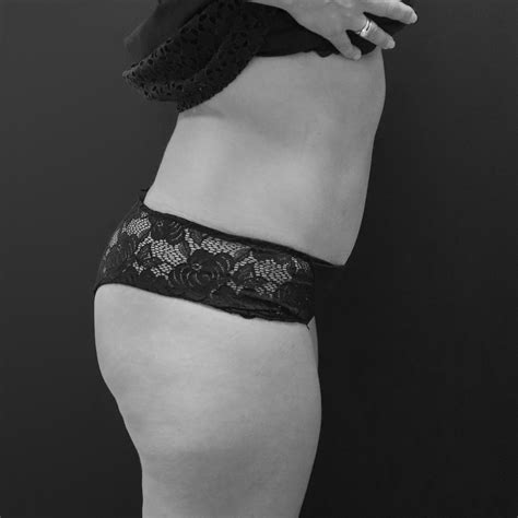 Abdominoplastie Avec Transposition De Lombilic Dr Amandine Bonte