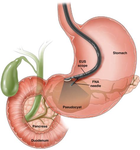 Endoscopic Retrograde Cholangio Pancreatography Ercp By Dr Chairyu