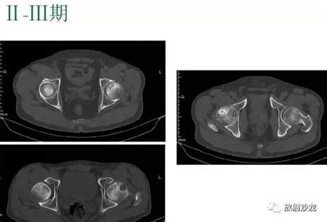 股骨头缺血性坏死丨分期及XCTMRI表现 MedSci cn