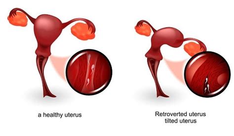 How Tilted Or Retroverted Uterus Or Cervix Impacts Pregnancy [video]