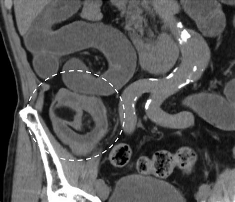 Successful Endoscopic Management Of Adult Ileocecal Intussusception Secondary To A Large Ileal