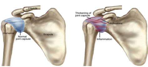 Frozen Shoulder Causes Symptoms And Effective Treatments Jack Nathan Rehab Physiotherapy