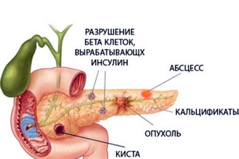 Виды панкреатита, симптомы, классификация, признаки заболевания