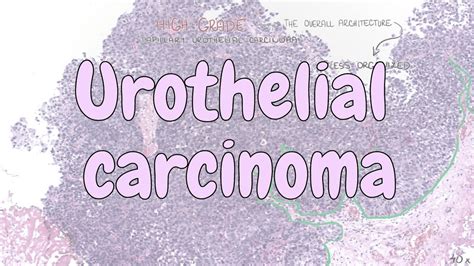 Urothelial Carcinoma Urinary System Pathology Youtube