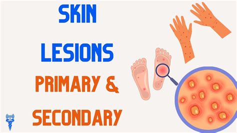 SKIN LESIONS Primary Secondary YouTube