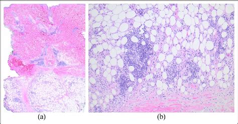 Figure From A Rare Case Of Suspected Lupus Erythematous Panniculitis