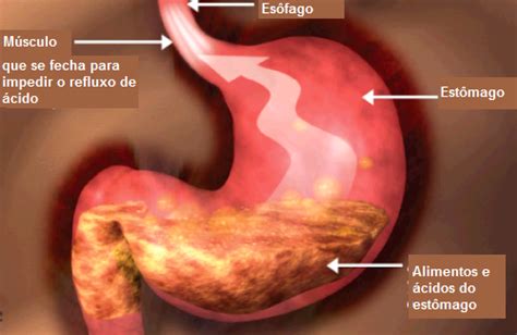 Doença do Refluxo Gastroesofágico