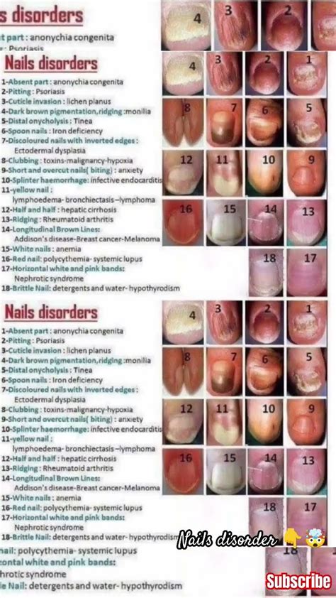 Nails Disorder Nails Disorders Sideeffect Shortsvideo Vidioviral