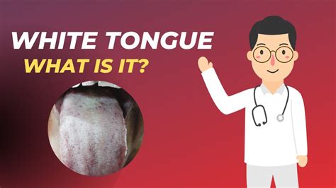 What Is White Tongue White Tongue Causes Home Remedy For Tongue