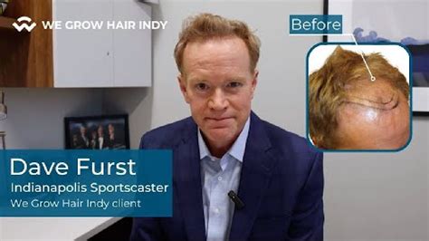 Introducing Dave Furst We Grow Hair Indys Newest VIP Hair Transplant