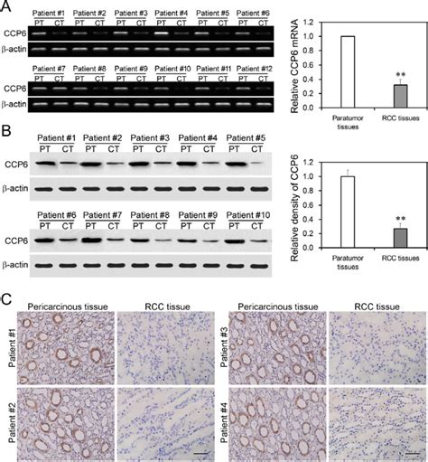 Downregulated Ccp Expression In Rcc Tissues A Rt Pcr Expression Of