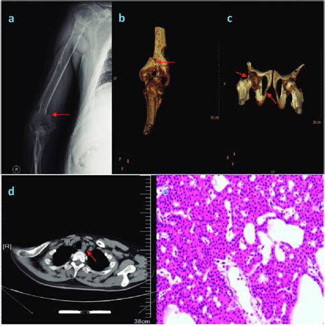 A X Ray Of The Right Humerus Showing A Right Humeral Fracture Red