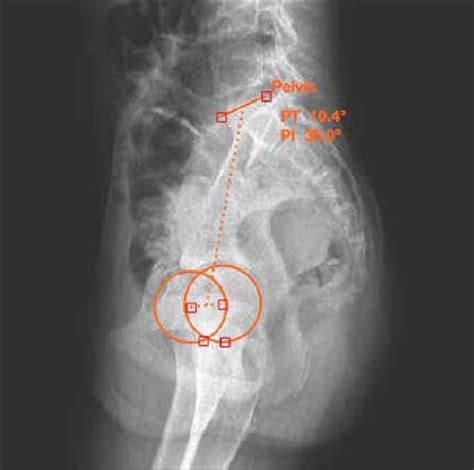 Measurement Of Sagittal Parameters By Surgimap Software Download