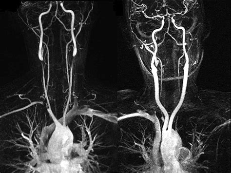 Takayasu Arteriitis European Journal Of Vascular And Endovascular Surgery