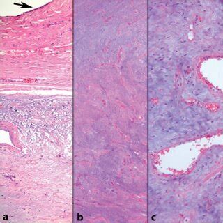 Hypocellular And Highly Myxoid Lesion Consisting Of Small Spindle Cells