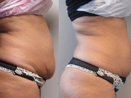 Coolsculpting O Melhor M Todo Para Reduzir A Gordura Localizada