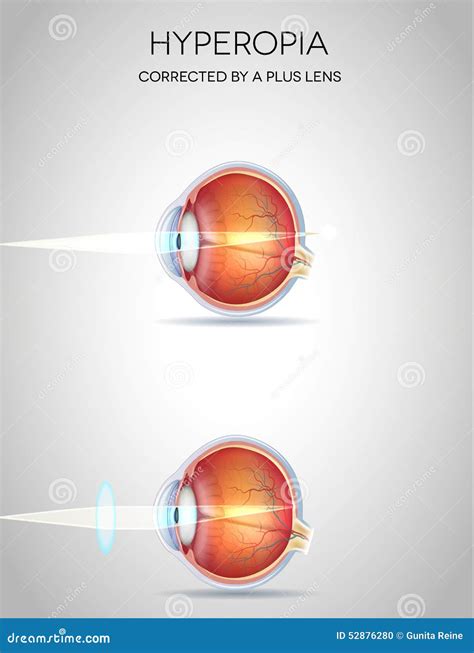 Hyperopia Stock Vector Image 52876280