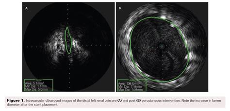 Nutcracker Syndrome A Rare Etiology Of Pcs Vdm