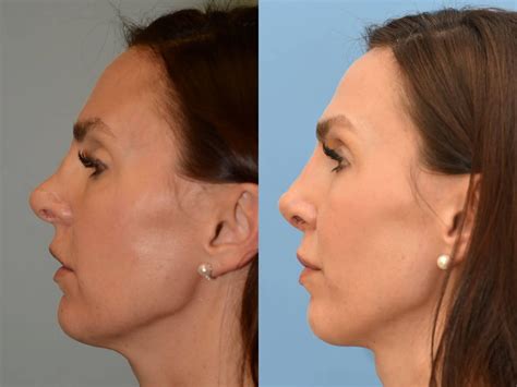 Revision Rhinoplasty For Houston Patient