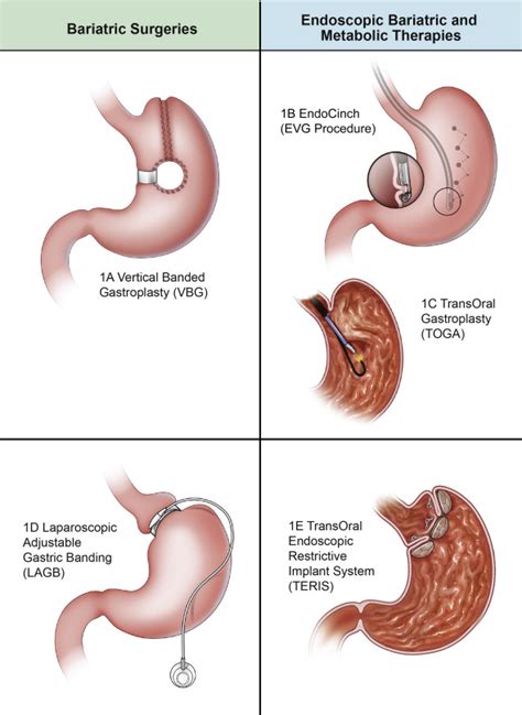 Endoscopic Bariatric And Metabolic Therapies Surgical Analogues And