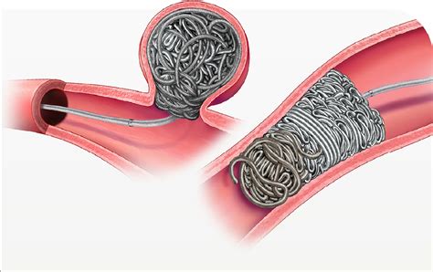 Peripheral Embolisation | Penumbra Inc