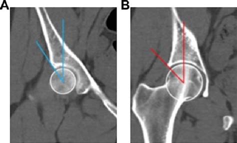 Figure From Relationship Between The Lateral Center Edge Angle And