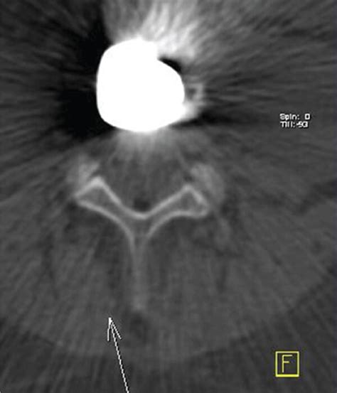 Examples Of Ct Beam Hardening Artifacts Caused By A Metallic Prosthesis