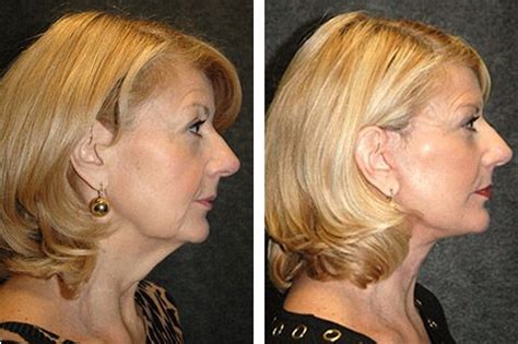 New York Facelift Specialist Dr Andrew Jacono Facelift Before And