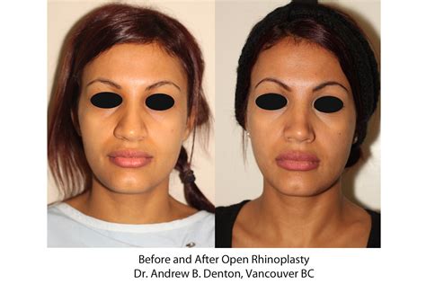 Before And After Open Rhinoplasty Dr Andrew B Denton Vancouver BC