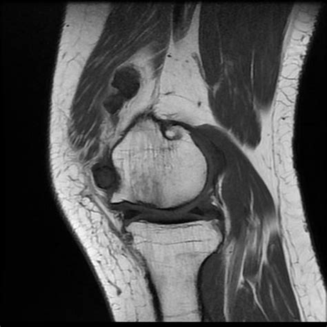 Synovial osteochondromatosis | Image | Radiopaedia.org