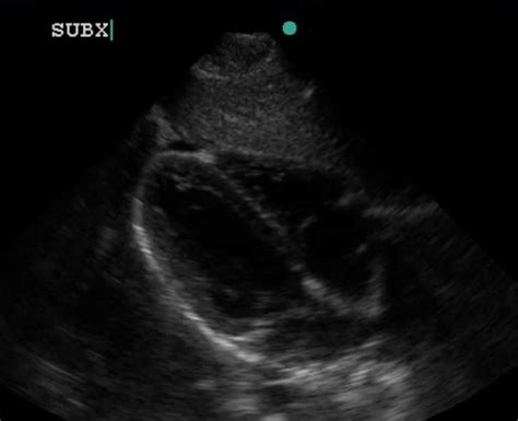 Ultrasound Series: The FAST Exam for unstable intra-abdominal bleeding