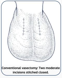 Best No Scalpel Vasectomy Procedure Circumcision Brisbane