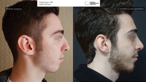 Nose Job Before After For Man 2 Months Result Ozge Ergun MD