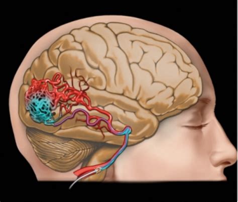 Embolizaci N De Malformaciones Arteriovenosas Cerebrales En Lima Per