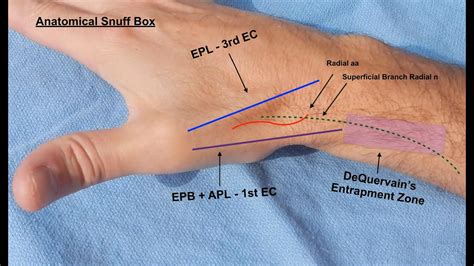 Live Surgery De Quervain S Tenosynovitis St Extensor Compartment