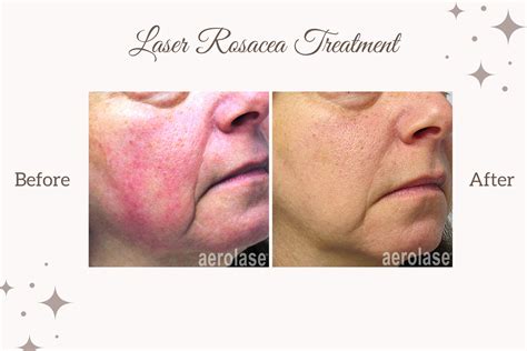 Why Use Laser For Rosacea Treatment — Taviemd Medspa